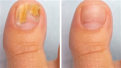 علاج فطريات الأظافر بالزيوت الأساسية